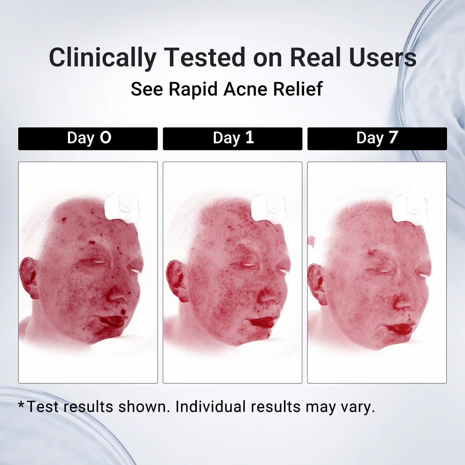 Dr.Leo Drying Lotion | Pimple Treatment & Body Acne Treatment | Visibly Shrinks Pimples in 24 Hours & Helps Fade Acne Marks in 7 Days | With 1.8%25 Encapsulated Salicylic Acid, 4%25 Niacinamide & 10%25 Sulfur (20ml) #mothersdaygift #Summervibe