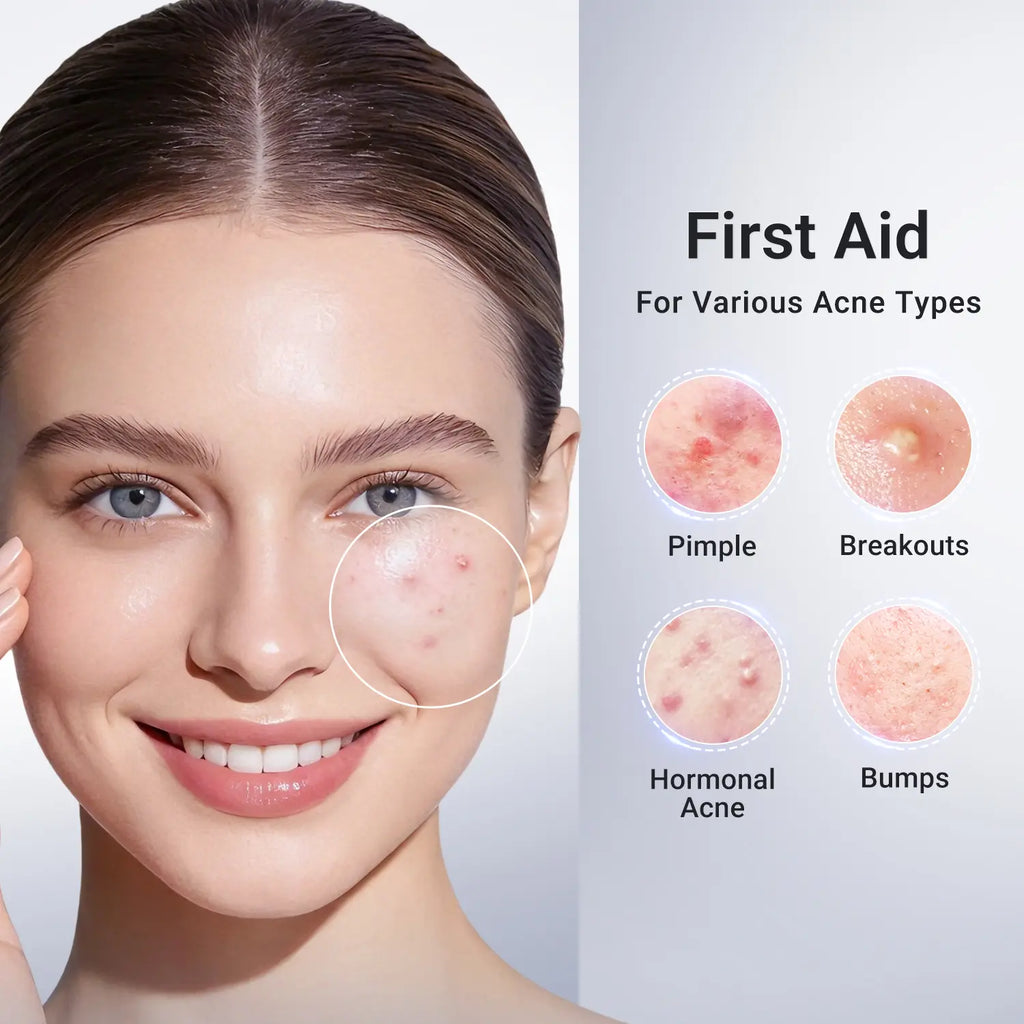 Dr.Leo Drying Lotion | Pimple Treatment & Body Acne Treatment | Visibly Shrinks Pimples in 24 Hours & Helps Fade Acne Marks in 7 Days | With 1.8%25 Encapsulated Salicylic Acid, 4%25 Niacinamide & 10%25 Sulfur (20ml) #mothersdaygift #Summervibe