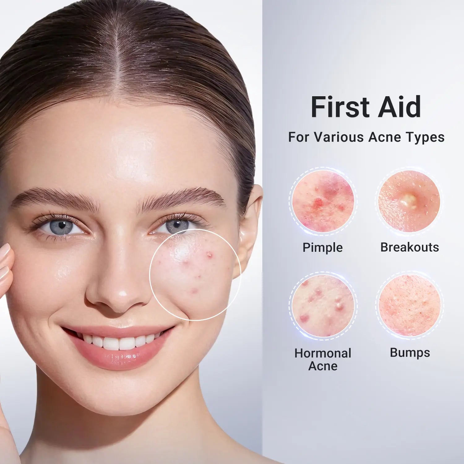 Dr.Leo Drying Lotion | Pimple Treatment & Body Acne Treatment | Visibly Shrinks Pimples in 24 Hours & Helps Fade Acne Marks in 7 Days | With 1.8%25 Encapsulated Salicylic Acid, 4%25 Niacinamide & 10%25 Sulfur (20ml) #mothersdaygift #Summervibe